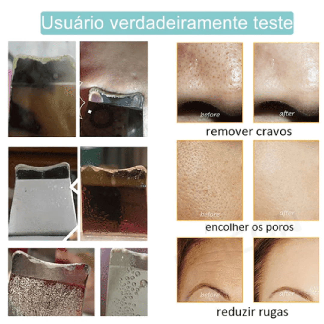 Esfoliador Ultrassônico de Pele da DermaSonic™ Removedor de Cravos e Limpador Facial com Cavitação | Loja Bosque