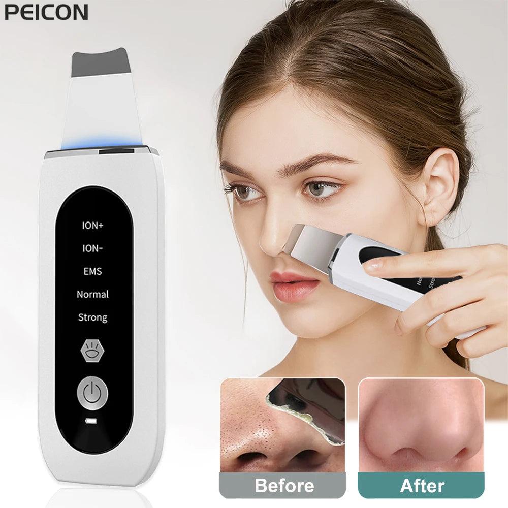 Esfoliador Ultrassônico de Pele da DermaSonic™ Removedor de Cravos e Limpador Facial com Cavitação | Loja Bosque
